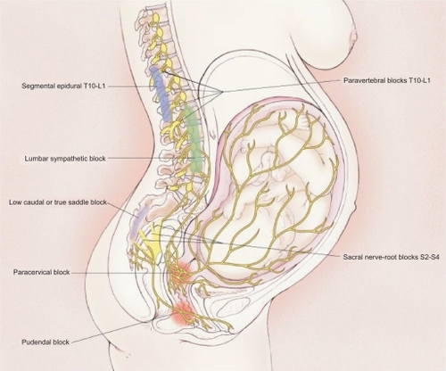 Figure 2 Transmission of labor pain. Labor pain has a visceral component and a somatic component. Noxious impulses from the uterus and cervix follow afferent sensory-nerve fibers that accompany sympathetic nerves, traveling through the paracervical region and the pelvic and hypogastric plexus to enter the lumbar sympathetic chain and the dorsal horn of the spinal cord through the white rami communicantes of the T10, T11, T12, and L1 spinal nerves. Noxious impulses from the vagina and perineum travel via the pudendal nerve to enter the spinal cord at S2 to S4. Reprinted with permission from Eltzschig HK, Lieberman ES, Camann WR. Regional anesthesia and analgesia for labor and delivery. N Eng J Med. 2003;348(4):319–332.Citation136 Copyright © 2003 Massachusetts Medical Society. All rights reserved.