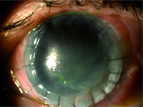 Figure 6 Corneal ulcer healing after 4 weeks of study treatment (V4).