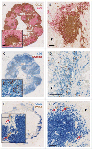 Figure 3. Characterization of T and B cells interaction in the gastric cancer microenvironment. Double immunohistochemical staining of gastric cancer patient tumor samples. Similar to normal lymph node (A) B cells aggregates (CD20: brown) are surrounded by T cells (CD3: pink) also in gastric cancer (B). DC-Lamp+ mature dendritic cells (DC-Lamp: red) were exclusively found in T cell zones (CD3: blue) both in normal lymph nodes (C) and in gastric cancer (D). In gastric cancer, these so-called tertiary lymphoid structures (TLS) are surrounded by PNAd+ high endothelial venules (HEVs: red arrows) (PNAd: brown; CD20: blue) (F), comparable to normal secondary lymphoid organs (E). Scale bar indicates 100 µm. T indicates tumor cells.