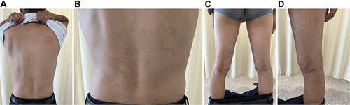 Figure 5 (A–D) Erythema, papules, scales on the shoulder (A), back (B), lower limbs (C) and popliteal fossa (D).