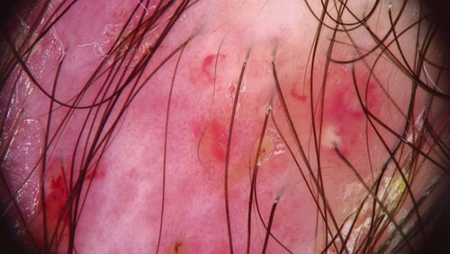 Figure 7 The hypergranulation variant of EPDS showing different types of vessels at trichoscopy.