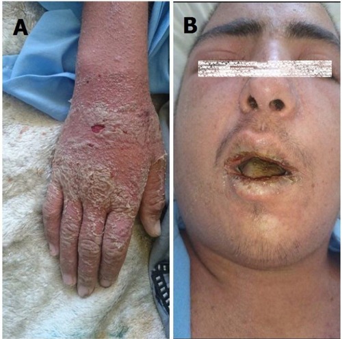 Figure 1 The physical examination of patient showed diffused maculopapular erythrodermic rash, and scaling in the distal extremities and around the nails (A) and severe conjunctivitis of the periorbital and the eyelids and also cracking and edema of the lips (B).