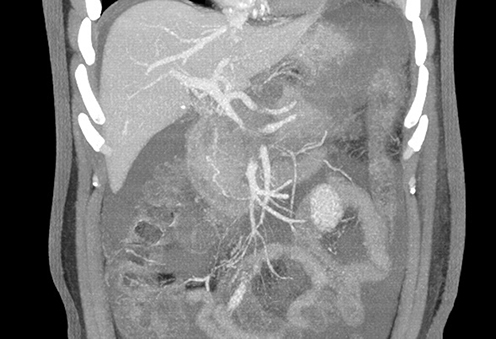 Figure 2 The abdominal enhanced CT results indicate the presence of venous thrombosis in the splenic vein, portal vein, and superior mesenteric vein.