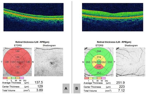 Figure 3 Optical coherence tomography (OCT) at the end of 1 year follow-up. (A) Gross retinal atrophy is visible in the right eye. (B) Normal OCT in the left eye.