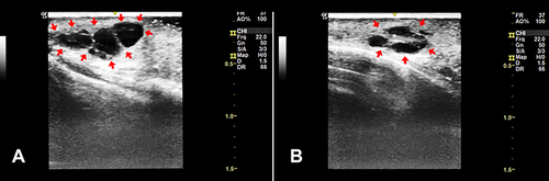 Figure 2 High-frequency ultrasound shows an anechoic cylindrical structure (red arrows) in the subcutaneous layer, with smooth margins, internal echoes and few septa, suggesting a hyaluronic acid pseudocyst. (A) Longitudinal view; (B) Axial view.