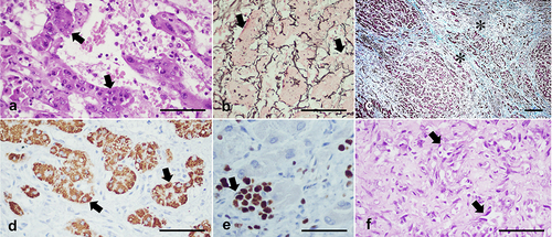 Figure 4 Histopathological and immunohistochemical assessments of tumors in DENA-treated animals. Hematoxylin-and-eosin (HE) evaluation in (a) showing trabecular pattern of HCC composed of variably thick trabeculae formed by neoplastic hepatocytes separated by vascular channels of various widths. Some trabeculae in this case are two cells thick and in other regions the hepatocytes pile together to form variably thick trabeculae (arrows). There are small foci of reticulin loss (arrows) among hepatocyte plates (b) in reticulin staining slide. Masson-Trichrome staining (c) revealed thick collagenous fibrous bundles (asterisks) surrounding the cirrhotic nodules in DENA-treated liver. Immunostaining of Hep Par-1 (d) intensely positive in trabeculae of tumor cells (arrows). A Ki-67 immunostaining (e) shows an increased proliferative rate in the liver of DENA-treated swine (arrow). A HE section of hepatic angiosarcoma (f) shows a densely cellular neoplasm made up of spindle cells that form different diameters of blood vessels. Bar = 50 μm.