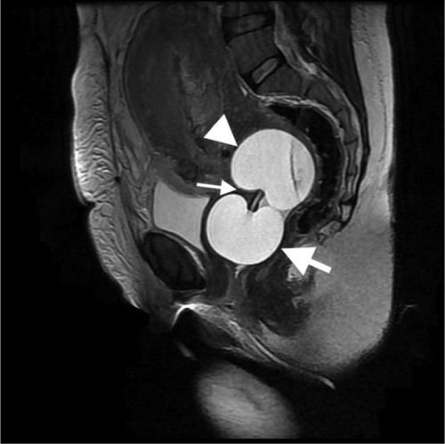 Figure 2 MRI image of cervical ripening catheter in Cesarean section patient.