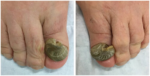 Figure 2. A 75-year-old female presented with painful bilateral great toenails for 10 years. Her nails grew slowly and were extremely difficult to clip. A full nail examination was significant for opaque yellow-brown thickening, hyperkeratosis, elongation, and increased curvature of the great toenails. Onychogryphosis can be differentiated from retronychia and onychomycosis by its spiral striated appearance [Citation13].