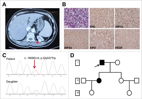 Figure 1. Characterization of the patient. (A) Computed tomography (CT) scan. Renal tumor is indicated by red arrow. (B) Hematoxylin and eosin staining (HE) and immunohistochemical staining of HIF1α, HIF2α, EPO, and VEGF in the tumor tissue. Magnification, 400 ×. (C) Sequence of HIF2α exon 12 in DNA purified from blood of patient (upper) and his daughter (lower). The heterozygous G>A substitution is indicated by a red arrow. (D) Patient family pedigree. □/○, normal male/female; ▪/•: male/female carrying the mutation. Patient and daughter are represented by a filled square (arrow) and filled circle, respectively.