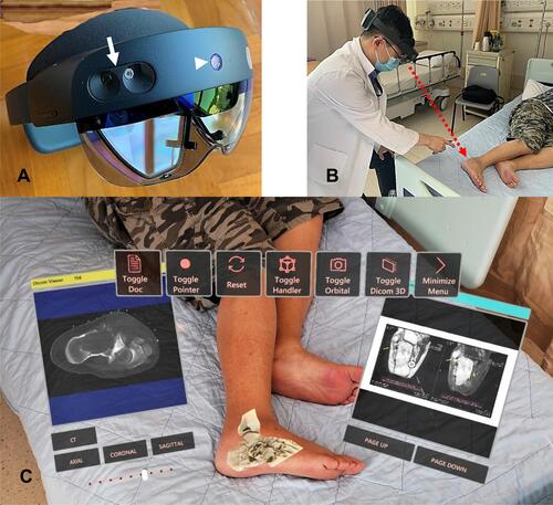 Figure 2 (A) shows the MR headset with a transparent near-eye-display, HoloLens 2 (Microsoft Corporation, Redmond, WA, USA). The Head-Mounted Display (HMD) has eye-tracking and hand tracking technology, with two cameras (white arrow) per eye. Eye-tracking is a technology that tracks the area the user is focusing on. The gaze can work as an input device like the mouse in a computer. Therefore, the technology allows interaction with holograms via gaze and hand gestures, and the user’s hands can still focus on the task. The HMD also includes an RGB camera (white arrowhead) for user-facing photo capabilities, like taking pictures and video, and live-streaming video of users’ point of view for remote assistance. (B) The author wears HoloLens 2 during the preoperative clinical assessment of a patient with the right calcaneal chondrosarcoma. The holographic contents are overlaid at the surgeon’s immediate real environment and are visualized from the surgeon’s point of view (red arrow). (C) depicts the User Interface of the authors’ developed MR platform. The MR HMD provides real-time, on-demand holographic medical information (CT/ MRI medical images in DICOM/PDF format or 3D bone model) at the clinical point of care while the surgeon can examine the patients with their hands. The system avoids the need for attention shift and eliminates line-of-site disruption, as in computer navigation surgery.