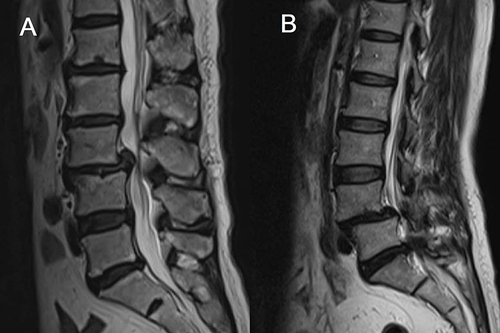 Figure 3 Lumbar spondylolisthesis (only type I and II were found in our patients). (A) type I spondylolisthesis, (B) type II spondylolisthesis.