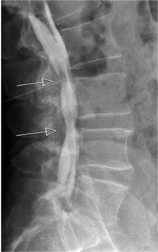 Figure 8. Myelography of the lumbar spine revealing spinal stenosis (arrows).