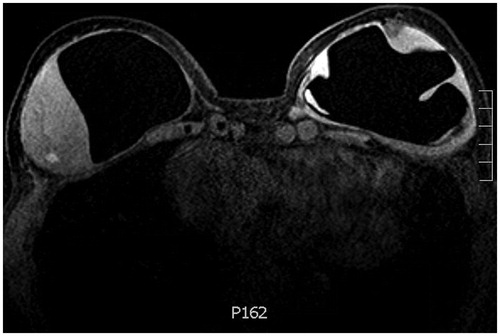 Figure 2. T1 weighted contrast bilateral breast MRI demonstrating a soft tissue intensity mass-like area attached to the right breast capsule with internal enhancing foci and trace periprosthetic fluid, in addition to enhancing foci at the deep margin of the left breast capsule.