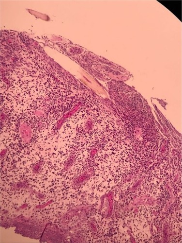 Figure 4 Hair root, stromal edema background with acute and chronic inflammatory cells accompanied by small congestive blood vessel proliferation.