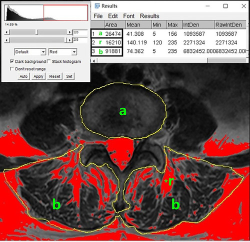 Figure 2 Axial T1-weighted MR image demonstrating measurement of the functional muscle-disc ratio by creating ROIs with ImageJ software. (A), L4/5 disc area. (B), cross-sectional area of paravertebral muscle. *r, bright pixels of fat tissue (with threshold >120) in ROIs are colored in red. M/D was defined as (b-r)/a.