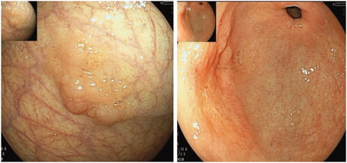 Figure 6. Two well-differentiated carcinomas in the corpus and antrum in the same patient were arisen from AMAG.