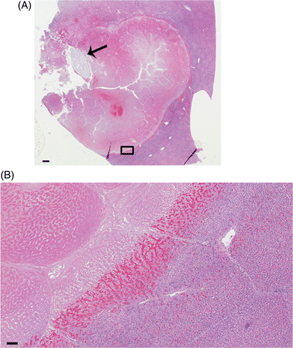 Figure 3 Histopathology of a thermochemical lesion. (A) Low magnification of representative ablation using 10 mol/L concentration of acid and base at 1 mL each. Lytic necrosis and cavitation are present immediately adjacent to the injection tract indicated by spaghetti (arrow) within a larger area of coagulative necrosis. 0.3× magnification, bar equals 1 mm. (B) Magnification view (small box at inferior margin of lesion) demonstrates coagulative necrosis (upper left), a well-demarcated haemorrhagic margin transitioning to congestion, and unablated tissue (lower right). H&E stain. 5× magnification, bar equals 100 µm.