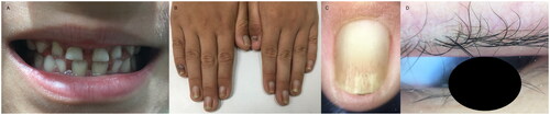 Figure 2. The patient’s milk teeth were hypoplastic and trapezoidal in shape (A); the patient’s nails were brittle, thick, and black, with heavy, yellowish longitudinal lines on the nail surface (B,C); and the patient’s eyelashes were seen to be desquamated at the roots, with dilated capillaries in a branch-like pattern (D).