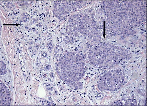 Figure 1.  LCIS. Classical type. Normal ductal epithelium (→) and LCIS (↓) (Haematoxylin/Eosin).