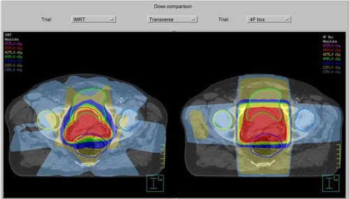 Figure 2 A side-by-side comparison of the relative dosimetries between an IMRT plan (left) and a 3-D conformal radiotherapy plan (right).Note: Photo courtesy of Dr Jenghwa Chang, PhD, from Weill-Cornell Medical College, New York-Presbyterian Hospital, New York, NY, USA.Abbreviations: IMRT, intensity-modulated radiation therapy; 3-D, three dimensional.