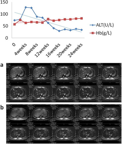 Figure 4 The improvement of ALT, hemoglobin, and LIC. Before DFO treatment, a patient had an abnormal liver function. Along with iron chelation therapy, his LPI decreased rapidly. Meanwhile, his ALT dropped and his hemoglobin increased gradually. Furthermore, his LIC decreased after receiving DFO treatment. Lane a: LIC was 9.97 mg/g dry weight on week 0. Lane b: LIC was 5.81 mg/g dry weight on week 26