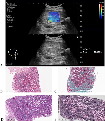 Figure 1. A representative example of shear wave elastography imaging (A) and histopathological analysis using various stainings (B-E). (A) A color-coded shear wave elastogram and a corresponding conventional ultrasound image of a patient with chronic kidney disease. Images of a 10× objective kidney biopsy stained with (B) hematoxylin-eosin stain, (C) Masson’s trichrome stain, (D) periodic acid-Schiff stain, and (E) methenamine silver stain taken from this patient.