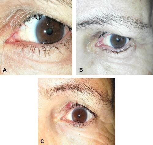 Figure 1 Preoperative photograph of a patient with lower eyelid TT (A). At 1 week postoperatively with the lid margin in a good position without trichiasis (B). At 6 months with recurrent trichiasis (C).