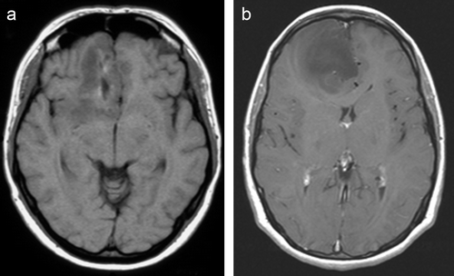 Figure 1.  MRI (T1-weighted images) of two patients with an oligodendroglioma (grade II) in the right frontal lobe, both presenting with focal epileptic seizures as the first symptoms. a) This patient became seizure-free on antiepileptic drugs after an initial seizure. b) This patient developed pharmacoresistent seizures in spite of multiple antiepileptic drugs.