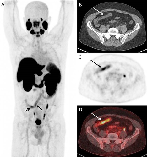 Figure 1 Long segment of abnormally increased [18F]DCFPyL uptake in the terminal ileum (identified by the black and white arrows in the subfigures). (A) [18F]DCFPyL PET/CT uptake in terminal ileum on a coronal plane. (B) Axial CT Image. (C) Axial PET Imaging. (D) Axial [18F]DCFPyL PET/CT fusion imaging.
