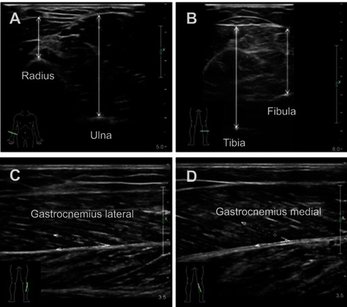 Figure 1 Typical ultrasound images. Transversal ultrasound images of anterior radial muscle and anterior ulnar muscle (A), posterior tibial muscle and posterior fibula muscle (B). Maximal muscle thickness was measured separately between the upper fascia to radius and ulna leading edge or to tibia and fibula trailing edge at the widest distance. Pennation angles were measured between muscle fiber and the deep fascia of the muscle (C and D).