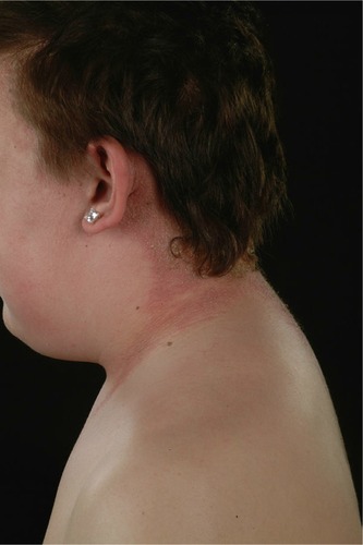 Figure 1 PPD allergy involving hairline.