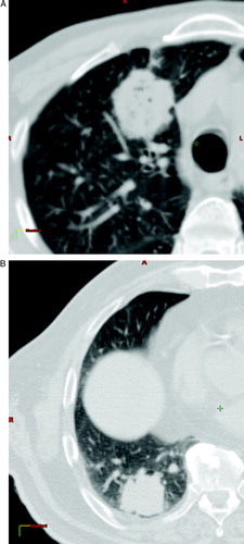 Figure 1.  Transversal CT slices in the central part of the tumours. a) Patient 1 with a tumour in the upper left lobe at the ventral part of the lung, close to sternum and ribs. b) Patient 2 with a tumour in the lower left lob close to diaphragm and ribs.