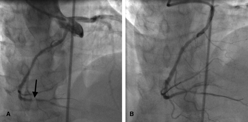 Figure 2.  (A) Anomalous RCA from left sinus of Valsalva pre-PCI in AP cranial projection with non-selective injection into aortic sinus showing distal RCA lesion (arrowed). (B) Post-PCI of RCA in AP cranial projection.