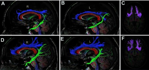 Figure 2 Tractograms of the patient (A, B, C) and a control subject (D, E, F). The control subject’s tractograms are of average size. The superior cingulum is in blue, the inferior cingulum is in green, and the corpus callosum is in red (A, B, D, E). The fasciculus uncinatus is in magenta (C, F). The patients’ tractograms (except for the corpus callosum) are markedly smaller than the tractograms of the control. R, Right side, L, Left side.