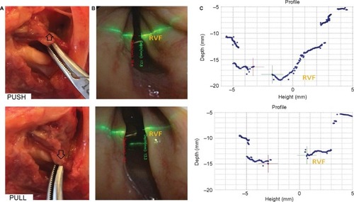 Figure 5 Simultaneous images of, (A) the arytenoid motion applied on the specimen by a mosquito forceps on the posterior crico-arytenoid muscle stump. The ‘push motion’ opens the crico-arytenoid joint and glides the arytenoid cartilage down internally on the cricoid cartilage. This lowers the VF. The ‘pull motion’ glides the arytenoid posteriorly on the cricoid crest. This elevates the VF. (B) The endoscopic image obtained with the LR video-endoscope showing the laser beam position. (C) The corresponding screen capture provided by the LR. Note the difference of heights between VFs visualized and quantified on the screen capture images. These differences are not clearly visible on two-dimensional endoscopic images.