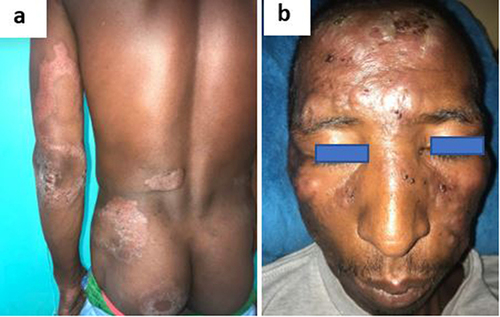 Figure 2 (a) Type 1 reaction with erythematous and swelling lesions; (b) type 2 reaction with erythema multiforme-like bullous lesions.