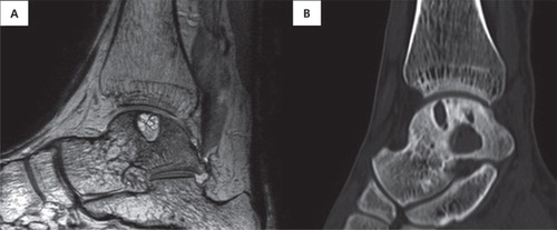 Figure 5. A 59-year-old man with OCL. (A) Initial MRI and (B) CT at 4-year follow-up. Although we recommended surgery to the patient at the first visit, the patient refused the operation because the symptoms were tolerable. The lesion size was increased on the CT at 4-year follow-up. However, the patient did not have worse symptoms and still did not want surgery.