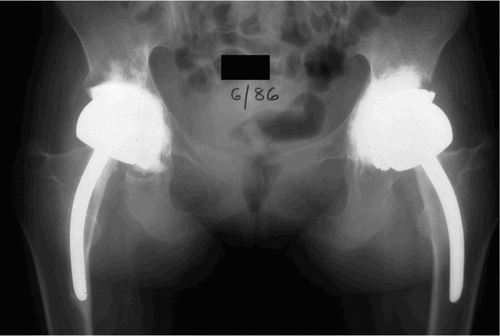 Figure 1. Case 5. Bilateral THR in a patient with bilateral failed resurfacing arthroplasties. Figure 1A. This patient has juvenile rheumatoid arthritis and underwent bilateral staged resurfacing arthroplasty several years previously.