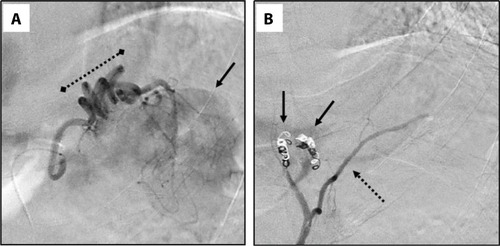 Figure 2 Selective angiogram and embolization of a gastric branch of the left phrenic artery perfusing the largest splenic nodule.