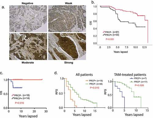 Figure 1. PRCP-positive BC patients have poor outcomes. A. Slides containing cores of breast cancer tissues were deparaffinized and stained with primary PRCP antibody (# HPA017065, Human Protein Atlas). PRCP displayed a granular cytoplasmic pattern. TMA staining was scored based on intensity (negative, weak, moderate, and strong) and percent cell staining. The criteria for PRCP positivity are that more than 60% of the cells have moderate to strong staining. B. Primary breast cancer tissues from 120 ER+/Her2- BC patients treated at Rush Medical Center from 2000–2005 were stained for PRCP. Kaplan-Meier curves show overall survival (OS) is significantly lower (P = .000) in PRCP positive (N = 33) patients compared with PRCP negative patients (N = 87). C. Primary breast cancer tissues of 32 ER+/Her2- BC patients (Fox Chase TMA) were stained for PRCP. Kaplan-Meier shows OS is significantly shorter (P = .016) in PRCP positive patients (N = 14) compared with PRCP negative patients (N = 18). D. Left panel: primary breast cancer tissues of 66 recurrent ER+/Her2- BC patients treated at UIC from 1994–2004 were stained for PRCP. Kaplan-Meier shows RFS is significantly shorter (P = .010) in PRCP positive patients (N = 18) compared with PRCP negative patients (N = 48). Right panel: among the 66 patients, 24 patients were treated with tamoxifen. Kaplan-Meier shows RFS is significantly shorter (P = .026) in PRCP positive patients (N = 7) compared with PRCP negative patients (N = 17).