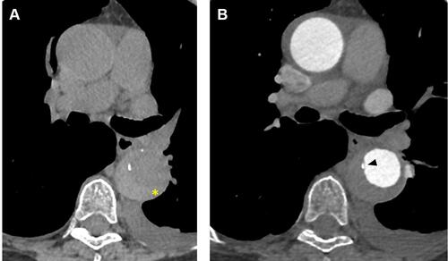 Figure 2 (A) Unenhanced computed tomography image where aortic intramural hematoma appears as a crescentic hyperattenuating thickening in the aortic wall (asterisk). (B) Same slice after contrast administration. The aortic intramural hematoma can be observed as non-enhanced crescent-shaped aortic wall thickening. Intimal calcification is characteristically displaced inward (arrowhead).