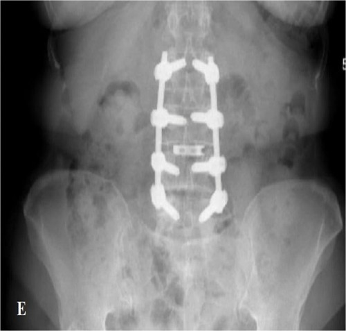 Figure 5 Postoperative AP view of the patient who underwent TLIF for L3 disc space.