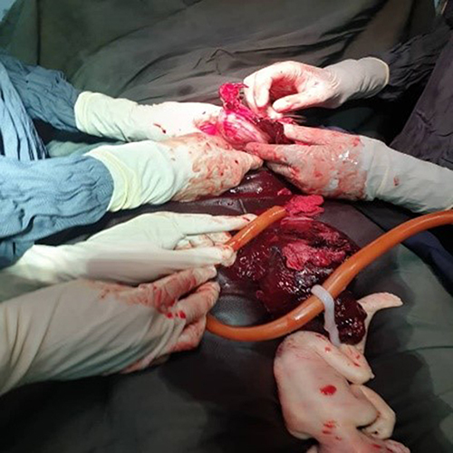 Figure 1 Shows freshly dead fetus with attached placenta and hemoperitoneum being suctioned.