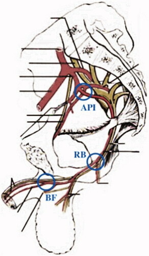 Figure 1. Set points of measurement along the internal pudendal artery. API: base of the internal pudendal artery. RB: distally to the rectal branch of the internal pudendal artery. BF: bifurcation of the bulbourethral artery and the dorsal artery of the penis.