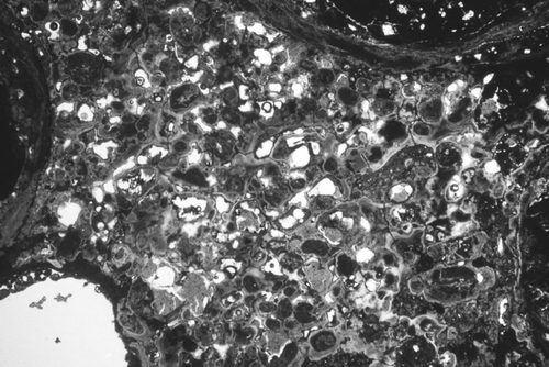 Figure 35 Optical thin-section view of the matrix between pisoliths where the matrix has been transformed into a series of blocky lumps of clay-sized earthy material surrounded by cutans. Field of view is 4 mm wide. From Ash pit, Andoom (ANU 46624).