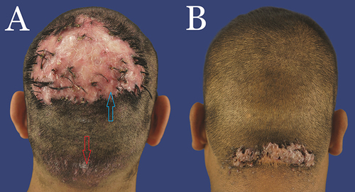 Figure 2 (A) Posterior view of a patient with histopathologically proven diagnosis of AKN in the nape area (red arrow) and FD in the entire vertex area (Blue arrow). There is a vast zone of NAS outside of the AKN and FD zones. (B) Posterior view of a patient with histopathologically proven diagnosis of AKN in the nape area. There is a vast zone of NAS outside of the AKN zone.