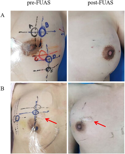 Figure 3. Skin safety after FUAS. (A) A 23-year-old woman with 8 FAs in the left breast. Left: pre-FUAS, skin marks of FA lesions were made under ultrasound imaging. Right: post-FUAS, the breast skin became a little pale after immersed in cold water, with no skin burn found after treatment. (B) A 35-year-old woman with a history of OS had 4 FAs in the right breast. Left: pre-FUAS, skin marks of FA lesions were made under ultrasound imaging. Right: post-FUAS, the breast skin became a little pale after immersed in cold water, with no skin burn found around the old scar (red arrow).