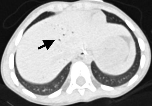 Figures 2. Abdominal computed tomography (CT) without contrast. Representative axial image confirms linear gas densities (arrow) within the hepatic dome.