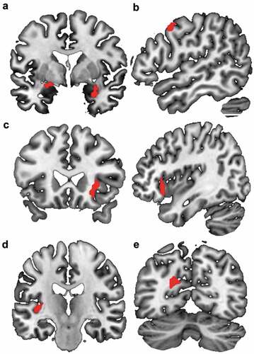 Figure 2. Brain representation of the significant clusters for the EMDR group (T1 (E1(CS+ vs CS-)-E6(CS+ vs CS-)))-T0(E1(CS+ vs CS-)-E6) minus wait-list group (T1 (E1(CS+ vs CS-)-E6(CS+ vs CS-)))-T0(E1(CS+ vs CS-)-E6) contrast. (a): right amygdala; left amygdala and hippocampus. (b): right BA8. (c): right BA47 and insula. (d): left Heschl gyrus. (e): left BA31. The factorial design analysis has evidenced six significant clusters when considering the EMDR group vs the Wait-List group for the contrast after minus before therapy for early E1 minus late E6 (CS+ minus CS-). Significance level was defined as cluster p-values < .05 after correction for family-wise error (FWE).