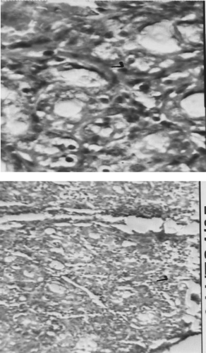 FIG. 3C Representative photomicrograph of thymus recovered from rats on Day 22 of the respective indicated treatment regimens (L = Lymphocytes, S = Sinusoid, HB = Hassel's Body. (C) Dexamethasone-treated rats. Left image at 10×, Right image at 40×.